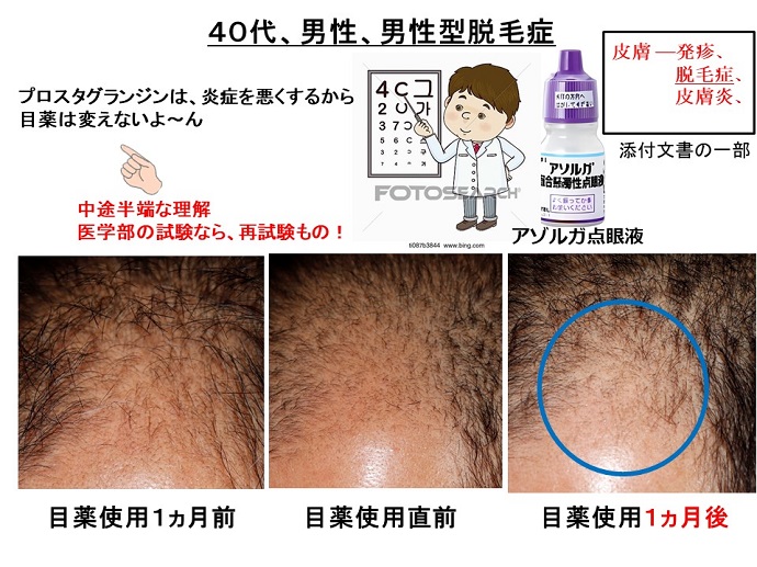 円形脱毛症　病院